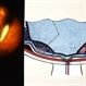 Proliferative Diabetic Retinopathy Cartoon (PDR)